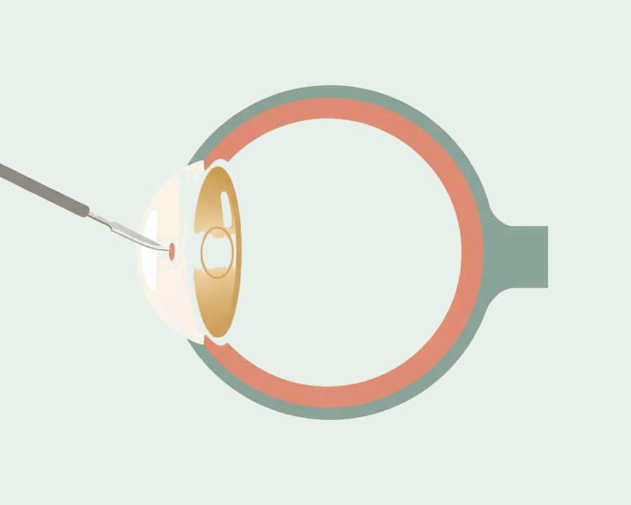 Illustration einer Linsenimplantation während einer Kataraktoperation im Auge.